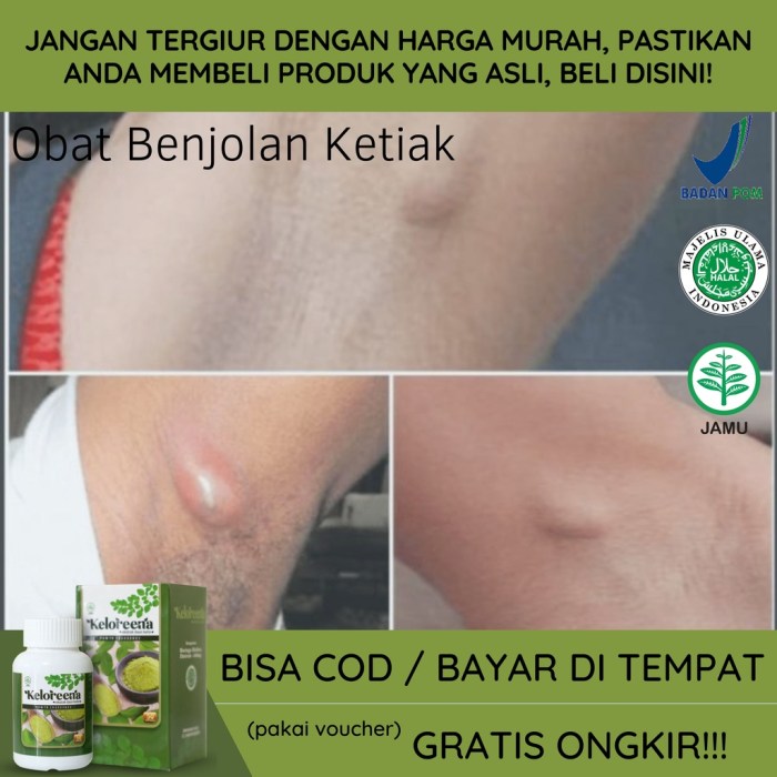 Cara mengobati benjolan di paha kanan