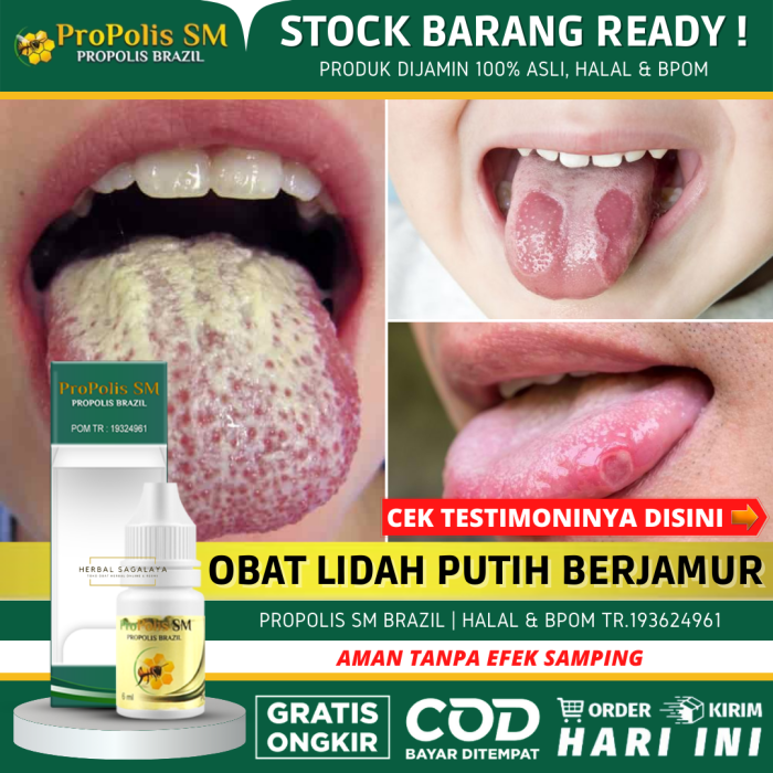 Cara membersihkan jamur di lidah