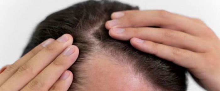 Cara mengatasi rambut pitak