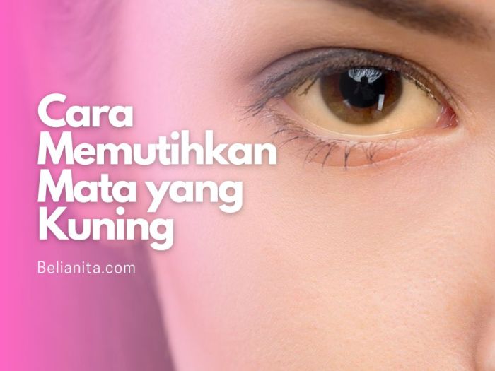 Cara membuat mata yang kuning menjadi putih