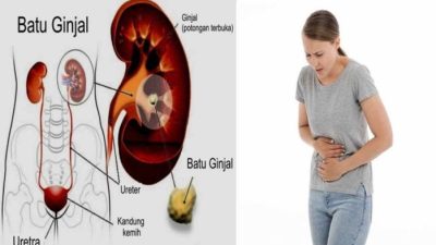 Cara pencegahan batu ginjal