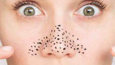 Cara ampuh menghilangkan komedo di hidung
