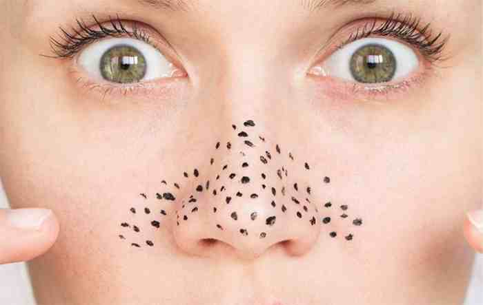 Cara ampuh menghilangkan komedo di hidung