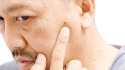 Cara menghilangkan daging tumbuh bekas jahitan