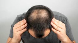 Cara mengatasi rambut pitak