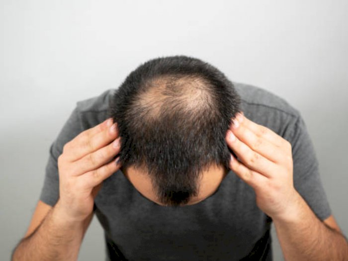 Cara mengatasi rambut pitak