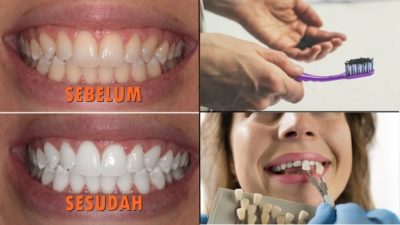 Cara Memutihkan Gigi Kuning: Panduan Lengkap untuk Senyum Cerah