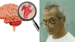 Cara Mengatasi Pembuluh Darah Pecah: Pencegahan, Diagnosis, dan Pengobatan