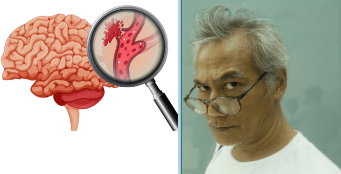 Pecah kaki mengobati