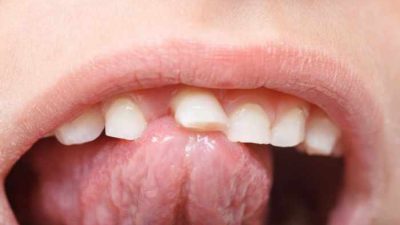 Tongue lidah tounge kondisi dan spots painful sehat gigi penyakit masalah sakit mulut dilihat strep sering sudah lidahmu mengecek belum