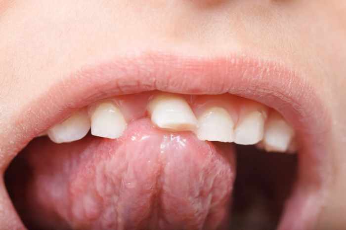 Tongue lidah tounge kondisi dan spots painful sehat gigi penyakit masalah sakit mulut dilihat strep sering sudah lidahmu mengecek belum