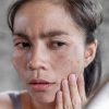 Cara Ampuh Hilangkan Hitam di Pipi