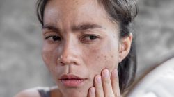Cara Ampuh Hilangkan Hitam di Pipi