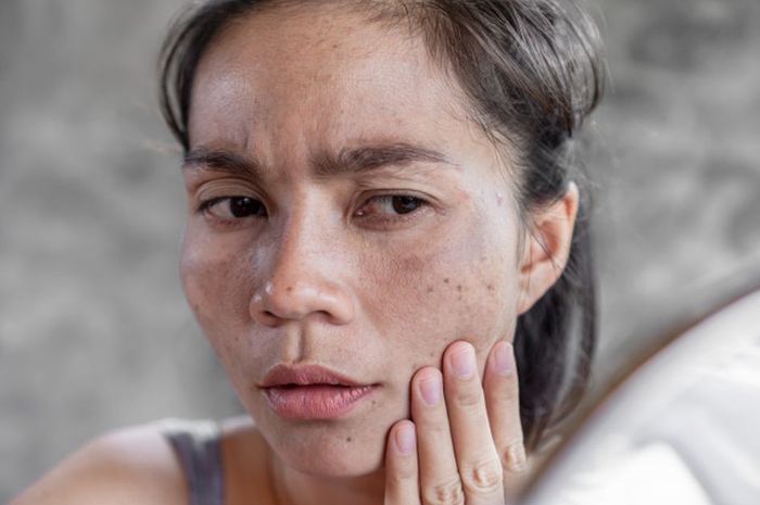 Cara menghilangkan hitam di pipi