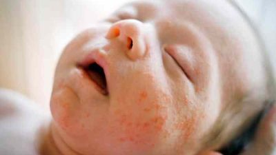 Cara menghilangkan jerawat untuk anak sd
