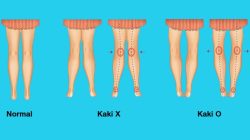 Cegah Kelainan Kaki O dan X: Panduan Lengkap