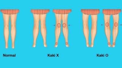 Bagaimanakah cara pencegahan terjadinya kelainan kaki o dan x