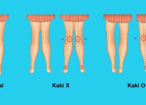 Cegah Kelainan Kaki O dan X: Panduan Lengkap