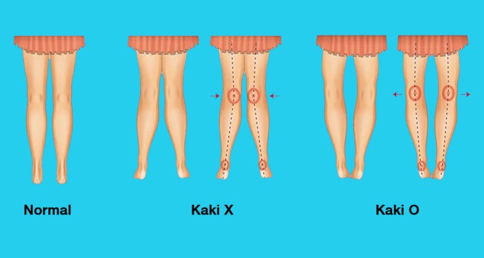 Bagaimanakah cara pencegahan terjadinya kelainan kaki o dan x