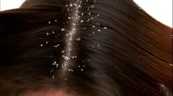 Cara agar rambut tidak ketombean