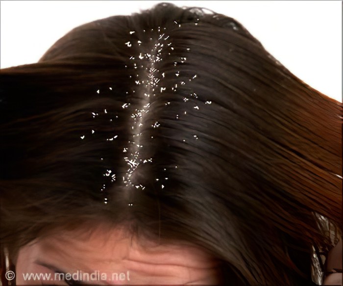 Cara agar rambut tidak ketombean