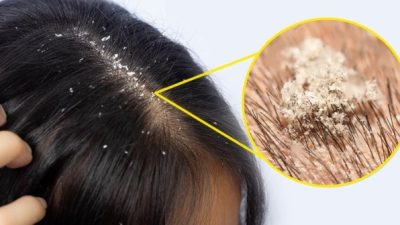 Cara agar rambut tidak gatal