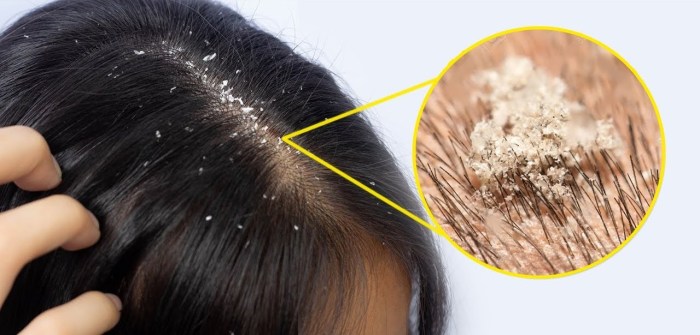 Cara agar rambut tidak gatal