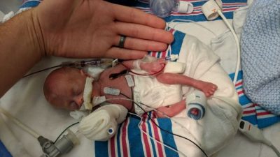 Cara merawat bayi prematur 8 bulan