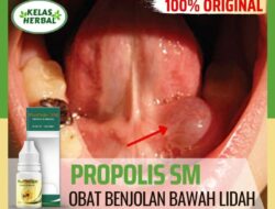 Cara Menghilangkan Benjolan di Lidah Penyebab, Pengobatan, dan Pencegahan