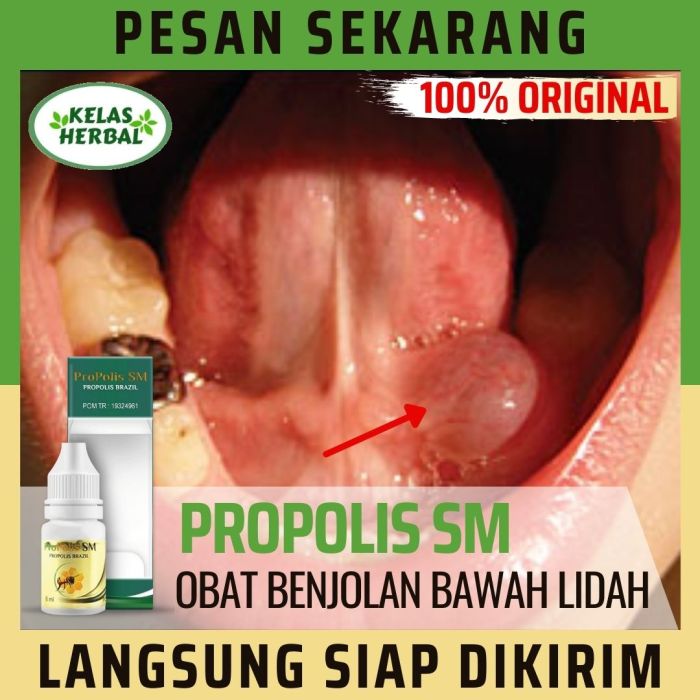 Cara menghilangkan benjolan di lidah