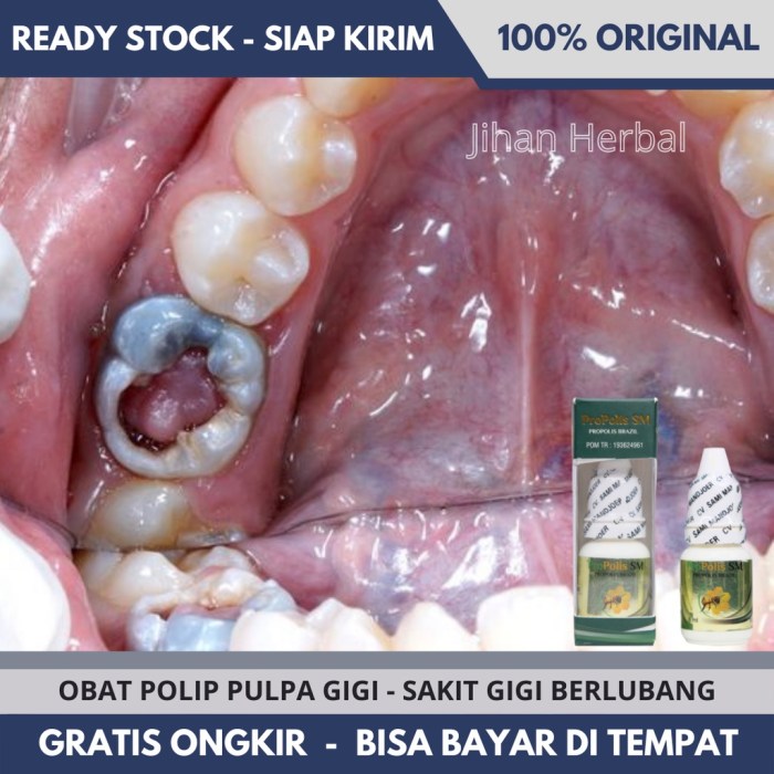 Cara mengobati polip gigi