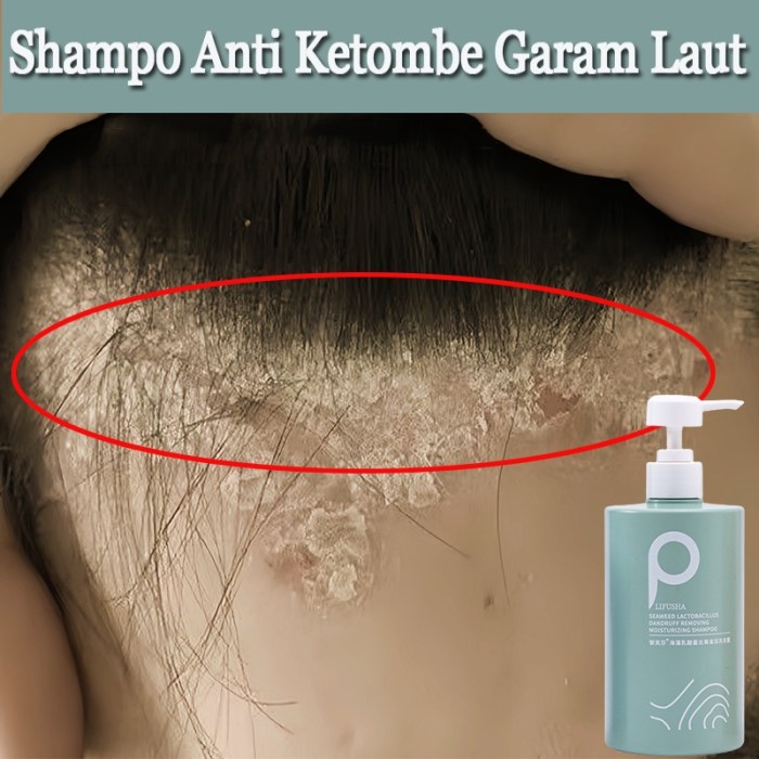 Cara mengatasi kepala gatal karena ketombe