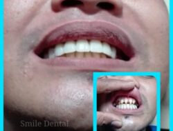 Cara Mengatasi Gigi Keropos yang Sakit Solusi Efektif dan Pencegahan Terbaik