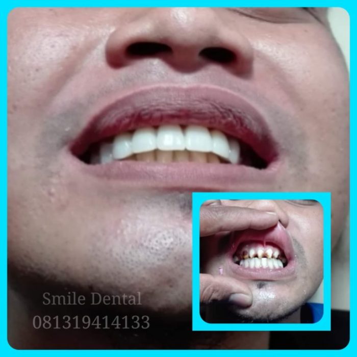 Cara Mengatasi Gigi Keropos yang Sakit Solusi Efektif dan Pencegahan Terbaik