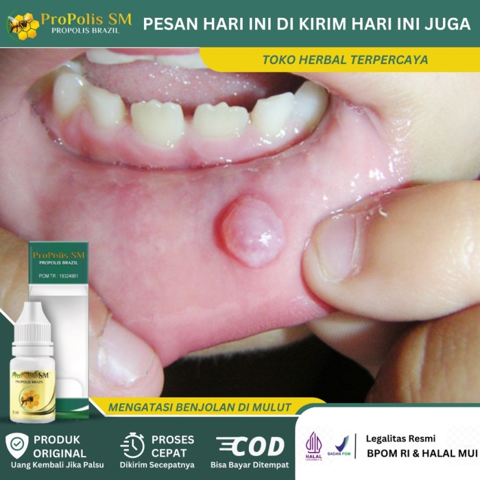 Cara menghilangkan benjolan di lidah