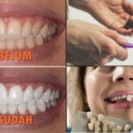 Cara Memutihkan Gigi Kuning: Panduan Lengkap untuk Senyum Cerah