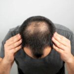 Cara Mengatasi Rambut Pitak: Solusi untuk Rambut Menipis