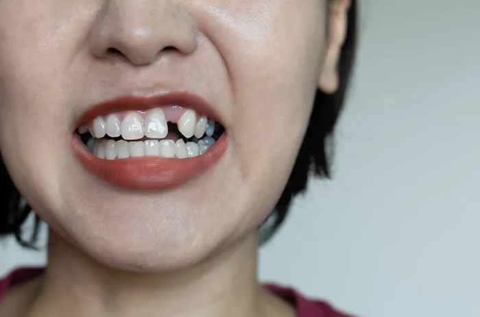 Cara Menaikkan Gigi yang Turun Panduan Lengkap untuk Senyum Lebih Sehat
