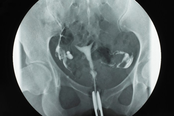 Cara membaca hasil hsg